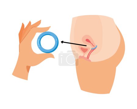 Illustration for Contraceptive diaphragm intrauterine isolated design - Royalty Free Image