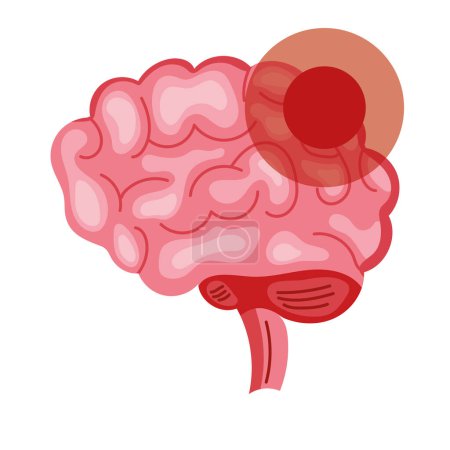 Illustrationsvektor für Parkinson-Erkrankungen im Gehirn