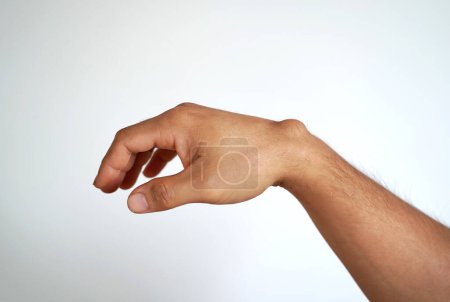 Ganglion cyst on mans hand on white background.