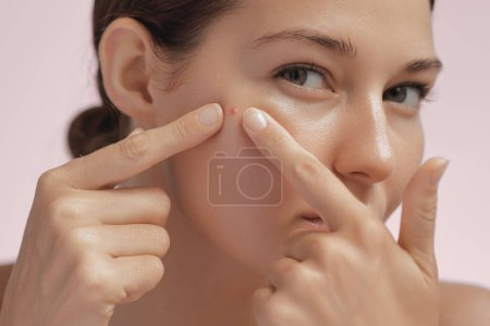 Photo for Skin problem. Depressed woman touching pimple on face looking at mirror. Facial skin issues, medical care, and treatment concept. Selective Focus. High-quality photo - Royalty Free Image
