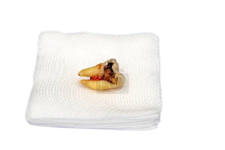 Téléchargez les photos : Une dent molaire cariée est extraite. Le sang n'a pas encore séché. Allongez-vous sur de la gaze blanche. Isolé sur fond blanc - en image libre de droit