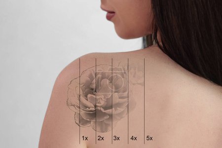 Téléchargez les photos : Laser Tattoo Removal On Woman's Shoulder. Medical Treatment - en image libre de droit