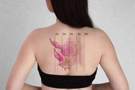 Téléchargez les photos : Laser Tattoo Removal On Woman's Back Against White Background - en image libre de droit