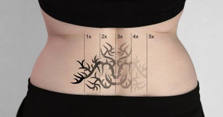 Téléchargez les photos : Vue arrière du retrait de tatouage au laser sur la hanche de la femme - en image libre de droit