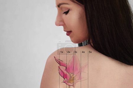 Foto de Laser Tattoo Removal On Woman's Shoulder. Medical Treatment - Imagen libre de derechos