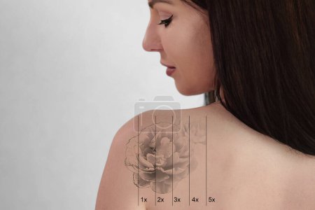 Téléchargez les photos : Laser Tattoo Removal On Woman's Shoulder. Medical Treatment - en image libre de droit