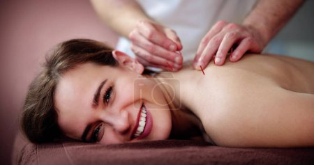 Photo for Dry Needle Acupuncture Treatment. Female Medical Spa Therapy - Royalty Free Image