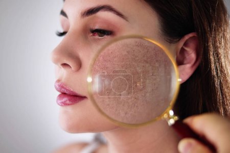 Rosácea Problema de la piel de la cara y tratamiento estético