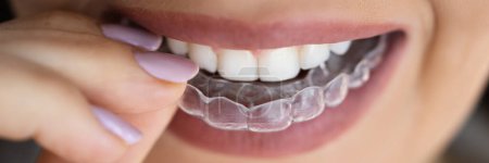 Téléchargez les photos : Garde de nuit dentaire claire d'alignement pour des dents - en image libre de droit