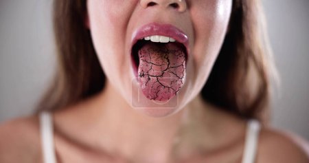 Téléchargez les photos : Douleur sèche de la langue et fissures. Candidose orale - en image libre de droit