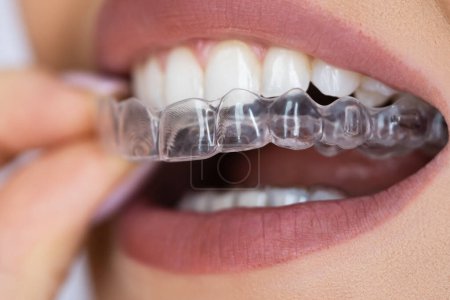Photo for Clear Aligner Dental Night Guard For Teeth - Royalty Free Image
