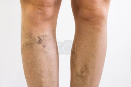 Photo for Before After Cellulite Inflammation Legs Treatment Closeup - Royalty Free Image