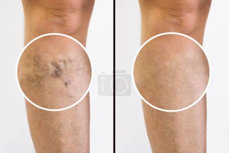 Photo for Person Leg With Varicose Veins And Capillaries Before And After Medical Treatment - Royalty Free Image