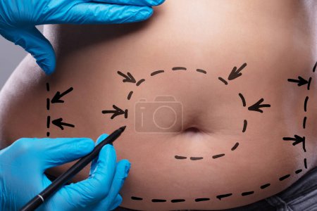 Foto de Primer plano del cirujano plástico en guantes azules dibujando en el estómago de la mujer con la pluma para la cirugía - Imagen libre de derechos