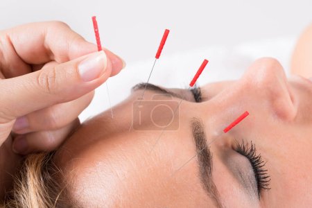 Primer plano de la mano realizando terapia de acupuntura en la cabeza en el salón
