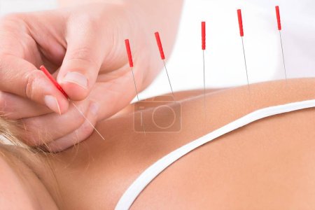 Foto de Primer plano de la terapia de acupuntura manual en la espalda del cliente en el salón - Imagen libre de derechos