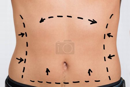 Téléchargez les photos : Gros plan de l'abdomen de l'homme avec des lignes de correction pour la chirurgie abdominale - en image libre de droit
