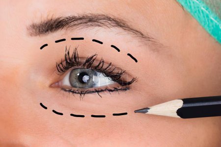 Foto de Primer plano de un cirujano dibujando líneas de perforación en la cara de una mujer joven para cirugía plástica - Imagen libre de derechos