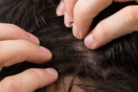 Photo for Cropped image of man suffering from hair loss against gray background - Royalty Free Image