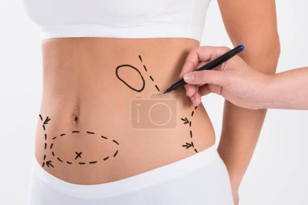 Foto de Imagen recortada del cirujano preparando a la mujer para la cirugía de liposucción sobre fondo blanco - Imagen libre de derechos