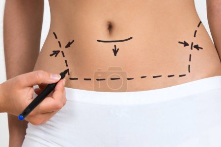 Photo for Person Hand Drawing Lines On Woman's Abdomen And Leg For Abdominal Cellulite Correction - Royalty Free Image