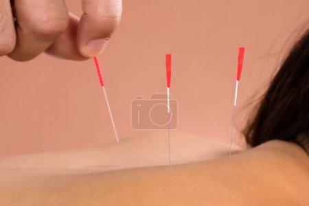 Téléchargez les photos : Gros plan d'une jeune femme souriante recevant un traitement d'acupuncture au spa - en image libre de droit
