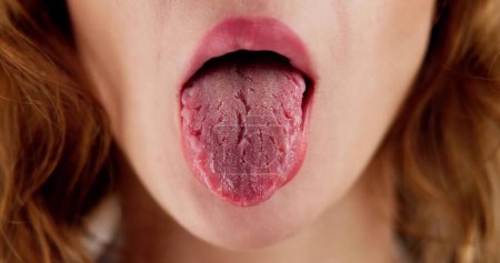 Photo for Dry Tongue Pain And Cracks. Oral Candidiasis - Royalty Free Image