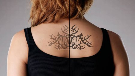 Foto de Eliminación de tatuajes láser en la espalda de la mujer. Piel corporal - Imagen libre de derechos