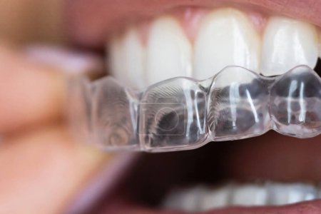 Téléchargez les photos : Aligneurs dentaires clairs - Garde de nuit pour un alignement parfait - en image libre de droit