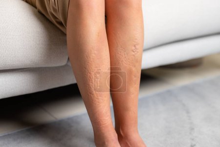 Téléchargez les photos : Femme souffrent de blessures aux jambes - en image libre de droit