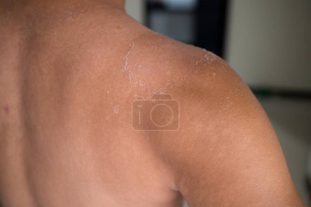 Téléchargez les photos : L'homme a des coups de soleil avec des bourrasques sur l'épaule - en image libre de droit