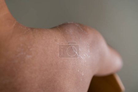 Téléchargez les photos : L'homme a des coups de soleil avec des bourrasques sur l'épaule - en image libre de droit