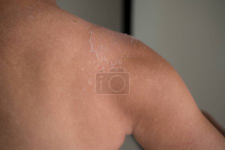 Photo for Man get sun burn with sloughs off on his shoulder - Royalty Free Image
