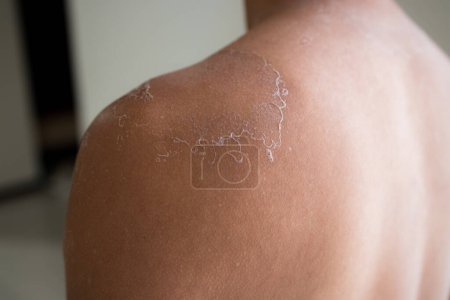 Photo for Man get sun burn with sloughs off on his shoulder - Royalty Free Image