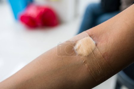 Téléchargez les photos : Plâtre et coton sur le bras de la femme après analyse de sang ou don de sang - en image libre de droit