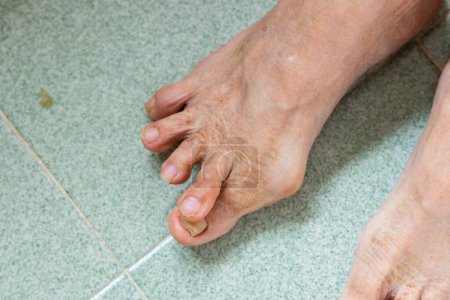 Foto de Asiática mujer sufren de seroso Hallux Valgus sobre los pies dedo del pie - Imagen libre de derechos
