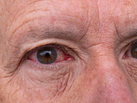 Téléchargez les photos : Gros plan de l "œil rouge irrité, appelé hyphéma - accumulation de globules rouges. - en image libre de droit