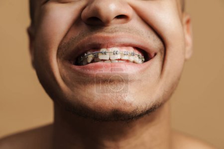 Téléchargez les photos : Jeune homme à poils montrant son appareil dentaire à la caméra isolé sur fond beige - en image libre de droit
