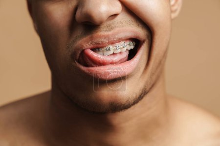 Téléchargez les photos : Jeune homme aux poils montrant son appareil dentaire et sa langue à la caméra isolé sur fond beige - en image libre de droit