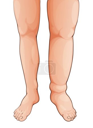 Edema swollen leg and foot. Lymphedema. Oedema disease symptom, fluid retention in legs, lymph circulatory problem and body tissue inflammation or thrombosis syndrome medical vector illustration