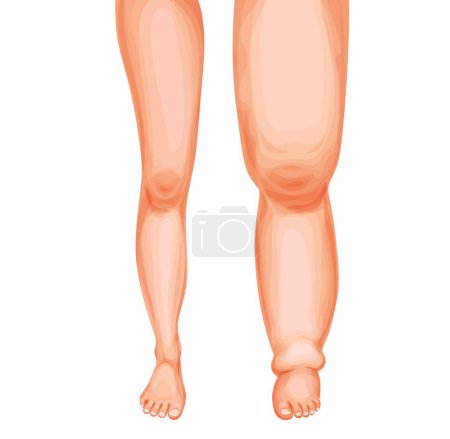 Illustration for Edema foot. Swollen leg and ankle, vector lymphedema or lymphoedema disease of lymphatic system. Cartoon human feets comparison, healthy and swollen legs, fluid retention, lymph circulatory problems - Royalty Free Image