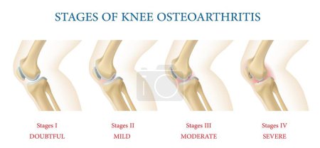 Illustration for Medical infographics. Knee joint osteoarthritis stages, vector chart of human body anatomy with knee bones, healthy and thinned cartilage. Joint pain, inflammation symptoms of osteoarthritis disease - Royalty Free Image
