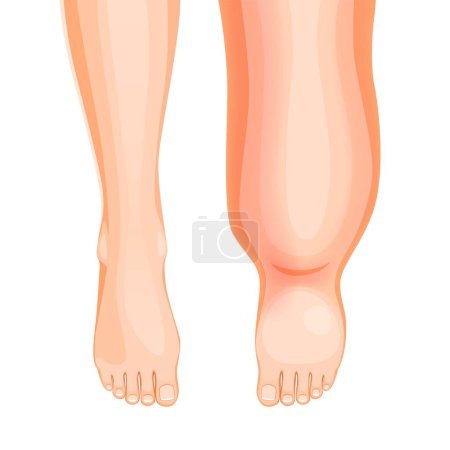Illustration for Edema foot. Swollen leg symptom. Fluid retention, thrombosis or tissue inflammation in legs, lymph circulation medical problem or overweight or oedema syndrome with vector swollen legs - Royalty Free Image