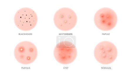 Illustration for Acne types, body or face skin pimples and inflammation problems, vector icons. Acne types, blackhead, pustule or whitehead, papule and cyst with nodules for skincare beauty cosmetology and dermatology - Royalty Free Image