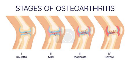 Estadios de osteoartritis de rodilla, articulaciones de rodilla humanas y anatomía ósea. Diagrama médico vectorial de las etapas de la artritis con cartílagos sanos y lesionados, inflamación artrítica, temas de medicina