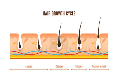 Ilustración de Ciclo de crecimiento del cabello fases vector sección transversal infografías. Anágeno, crecimiento activo, catágeno transicional, telógeno en reposo. La representación visual de los folículos pilosos se somete a etapas de regeneración continua - Imagen libre de derechos