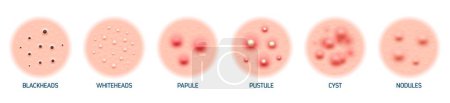 Illustration for Body skin acne type blackheads, whiteheads, papule, pustule, cyst and nodules. Realistic 3d vector skin conditions characterized by inflamed sebaceous glands, leading to pimples on face or back - Royalty Free Image