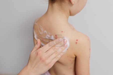 Photo for Child back infected with chickenpox is having treatment using antiseptic foam by hand - Royalty Free Image