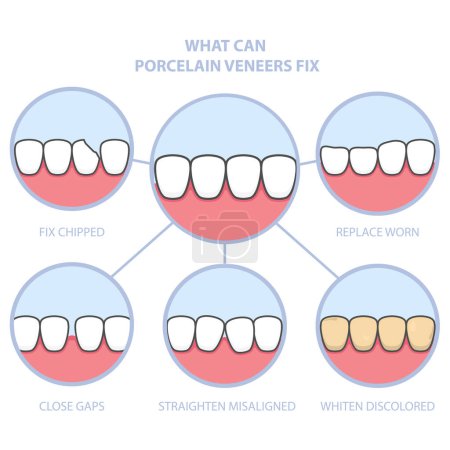 Illustration for Teeth and smile makeover with dental ceramic veneers, row of teeth fixed with veneer cover, before and after teeth, vector - Royalty Free Image