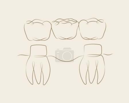 Téléchargez les illustrations : Dents avec dessin d'illustration de pont couronne en style linéaire sur fond beige - en licence libre de droit